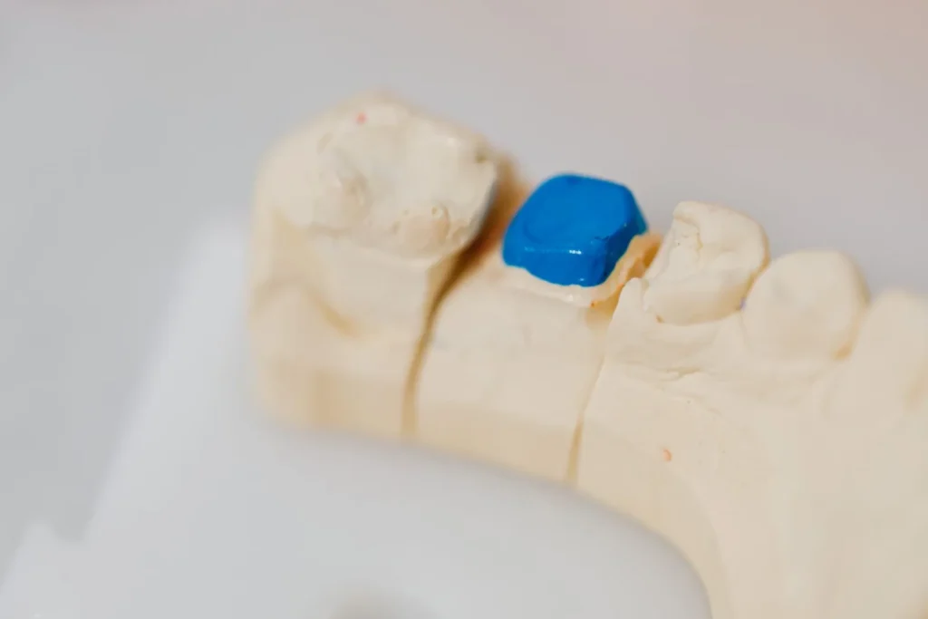 Example of a dental filling on a tooth model