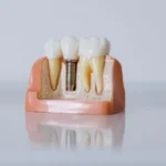 Dental implant treatment: model of an implant placed in the jawbone with a crown on top
