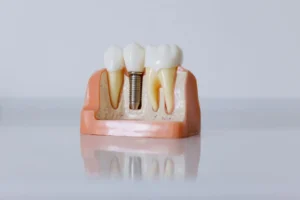 İmplant tedavisi: çene kemiğine yerleştirilen implant ve üzerindeki kron modeli