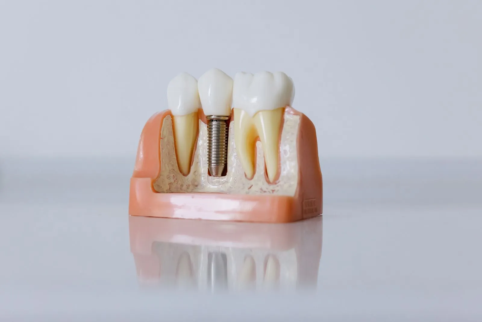 İmplant tedavisi: çene kemiğine yerleştirilen implant ve üzerindeki kron modeli